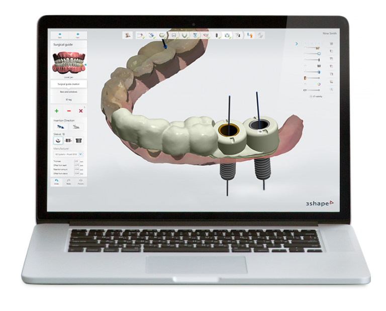 3D Digital Impressions West Columbia SC, Sunset Periodontics & Implant Dentistry