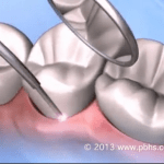 Lanap Surgery