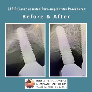lapip laser periodontal